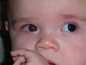 Mia wearing the occluding lens