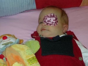 first eye patch at 4 months