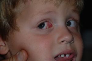 conjunctival cyst Nicolas' eye